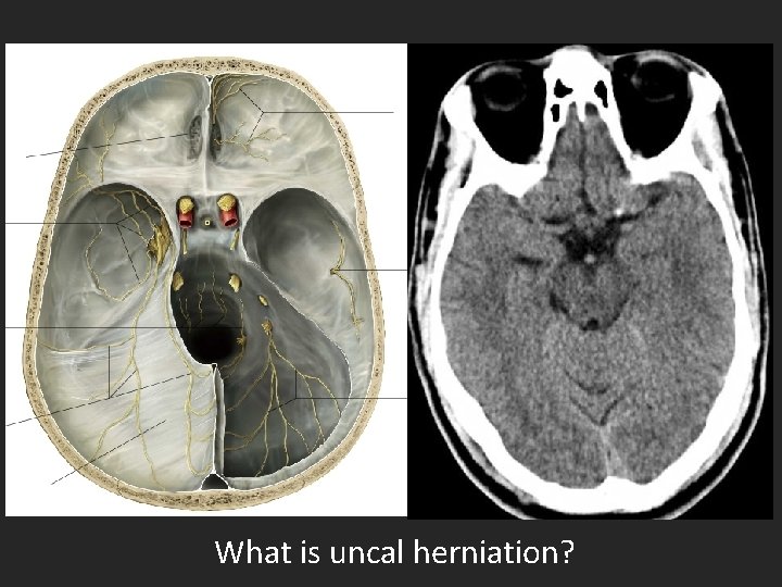 What is uncal herniation? 