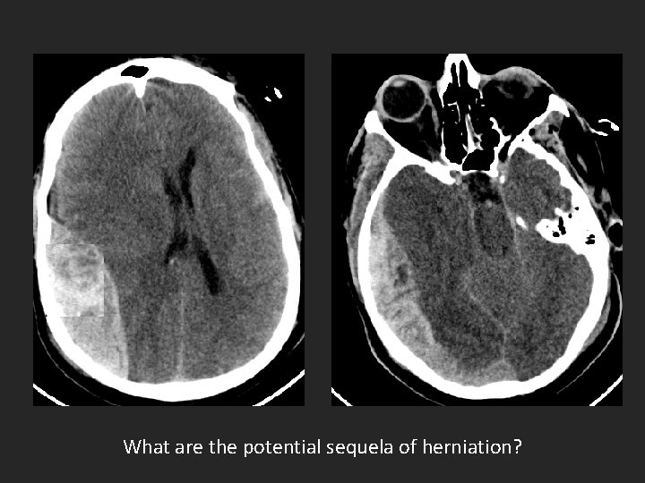 What are the potential sequela of herniation? 