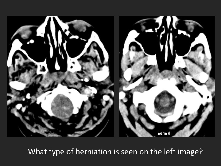 normal What type of herniation is seen on the left image? 