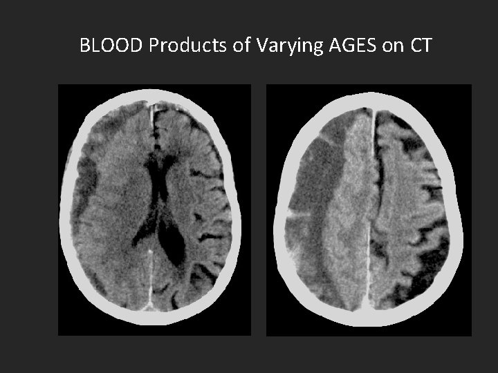 BLOOD Products of Varying AGES on CT 