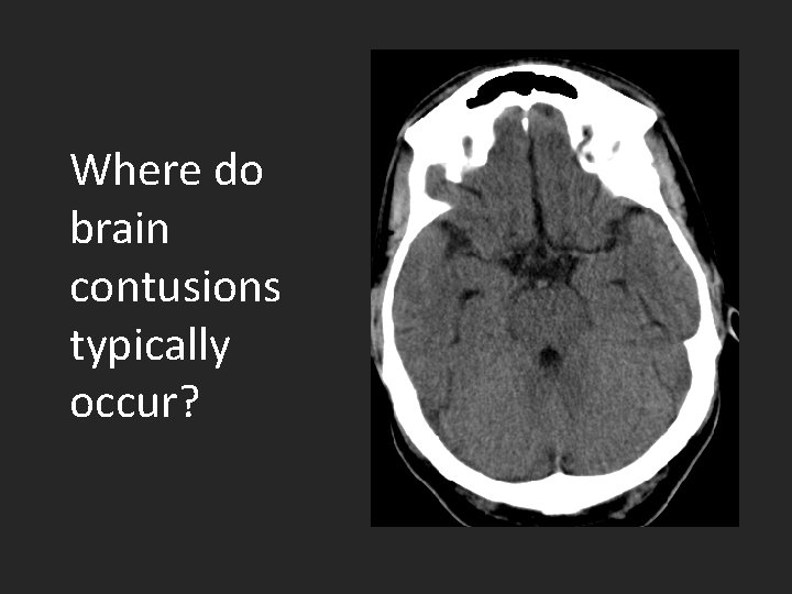 Where do brain contusions typically occur? 