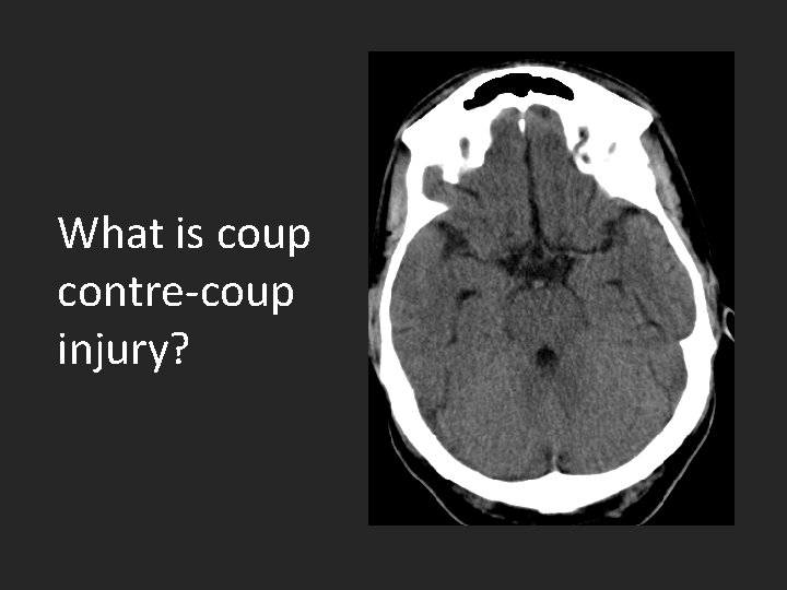 What is coup contre-coup injury? 
