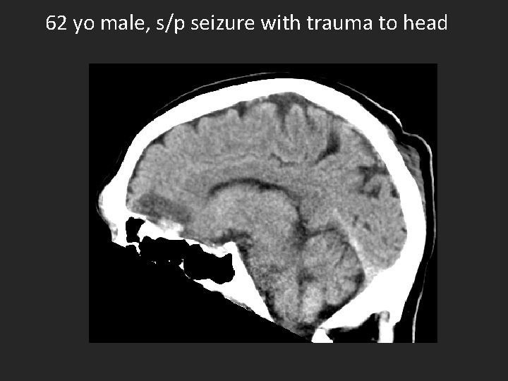 62 yo male, s/p seizure with trauma to head 