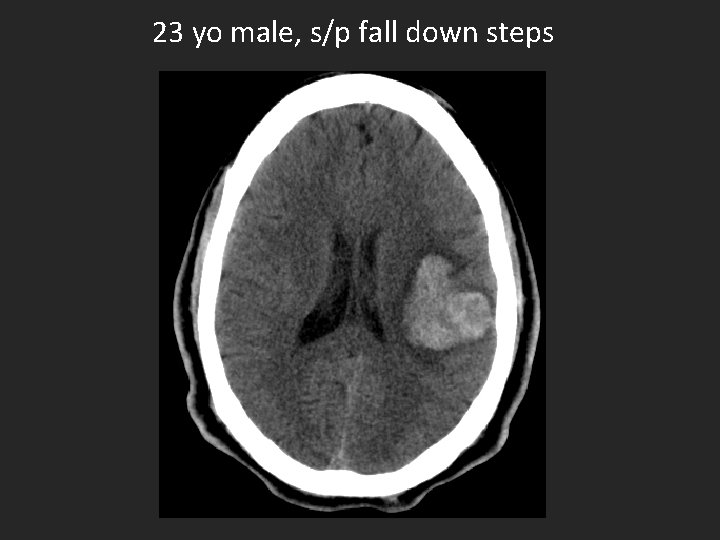 23 yo male, s/p fall down steps 