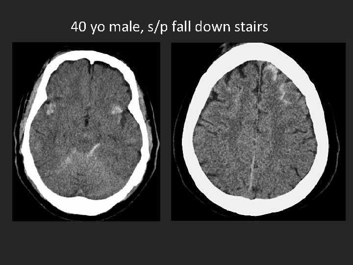 40 yo male, s/p fall down stairs 
