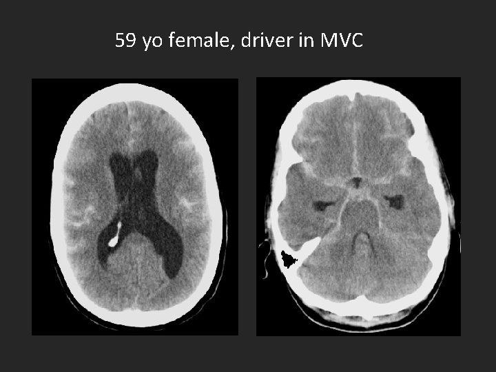 59 yo female, driver in MVC 
