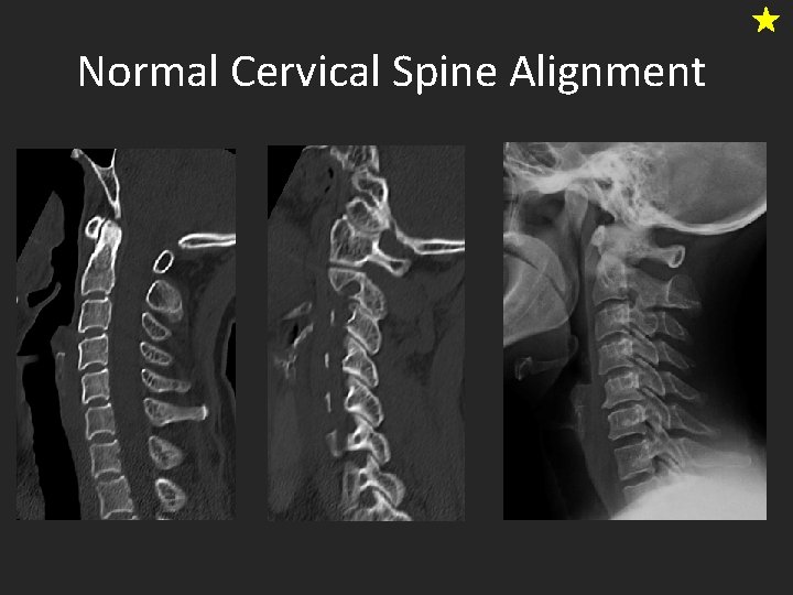 Normal Cervical Spine Alignment 