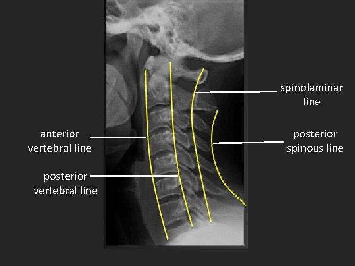 spinolaminar line anterior vertebral line posterior spinous line 