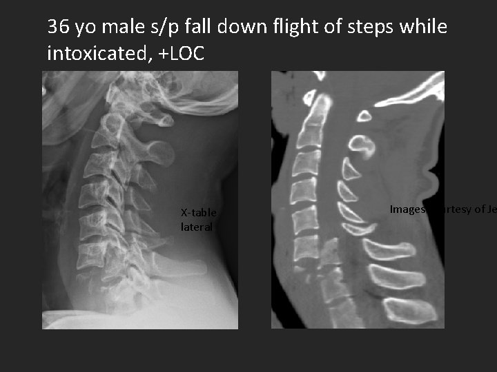 36 yo male s/p fall down flight of steps while intoxicated, +LOC X-table lateral