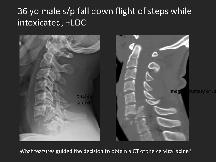 36 yo male s/p fall down flight of steps while intoxicated, +LOC X-table lateral
