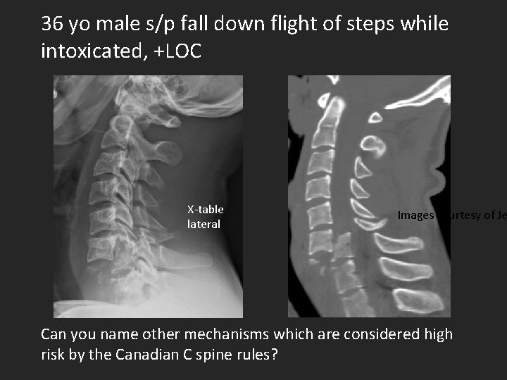 36 yo male s/p fall down flight of steps while intoxicated, +LOC X-table lateral
