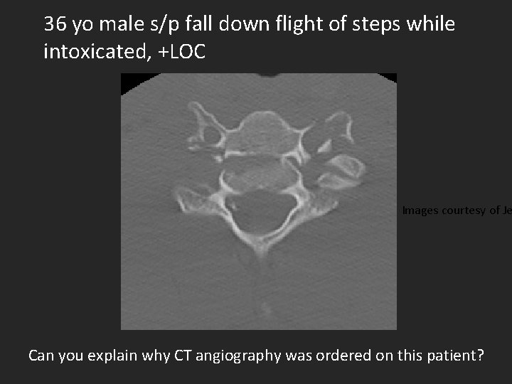 36 yo male s/p fall down flight of steps while intoxicated, +LOC Images courtesy