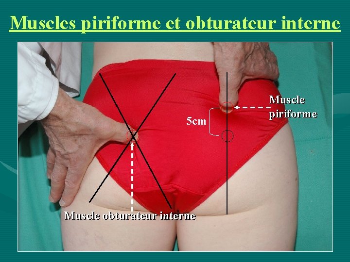 Muscles piriforme et obturateur interne 5 cm Muscle obturateur interne Muscle piriforme 