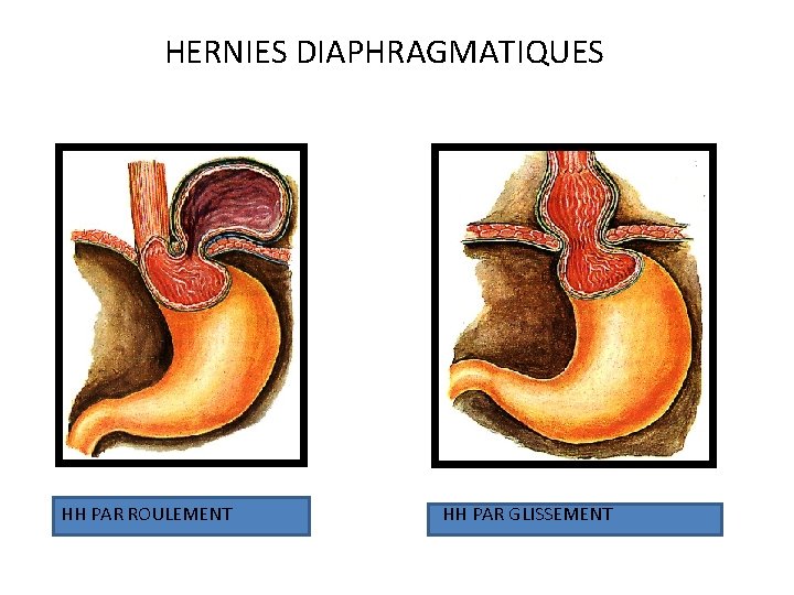 HERNIES DIAPHRAGMATIQUES HH PAR ROULEMENT HH PAR GLISSEMENT 