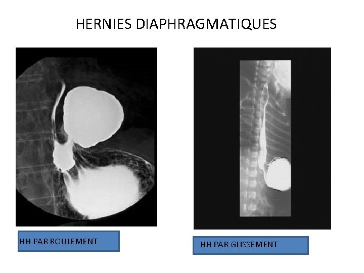 HERNIES DIAPHRAGMATIQUES HH PAR ROULEMENT HH PAR GLISSEMENT 