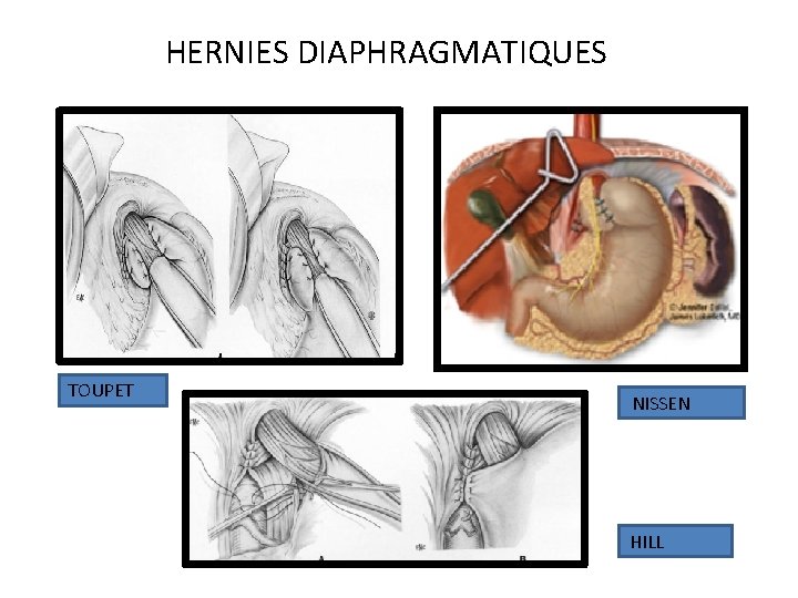 HERNIES DIAPHRAGMATIQUES TOUPET NISSEN HILL 