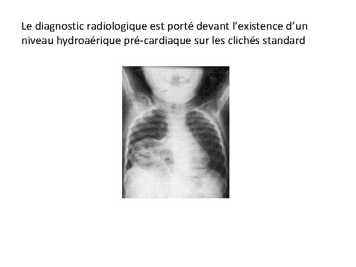 Le diagnostic radiologique est porté devant l’existence d’un niveau hydroaérique pré cardiaque sur les
