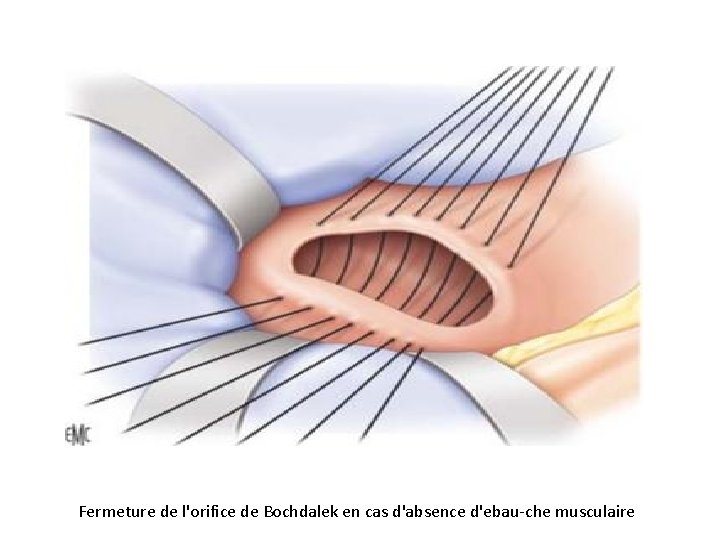 Fermeture de l'orifice de Bochdalek en cas d'absence d'ebau che musculaire 