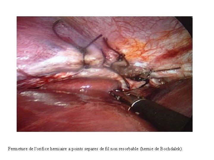 Fermeture de l'orifice herniaire a points separes de fil non resorbable (hernie de Bochdalek).