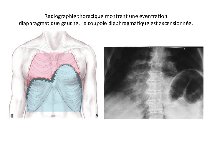 Radiographie thoracique montrant une éventration diaphragmatique gauche. La coupole diaphragmatique est ascensionnée. 