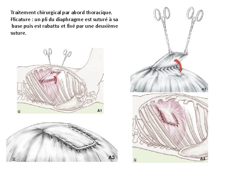Traitement chirurgical par abord thoracique. Plicature : un pli du diaphragme est suturé à