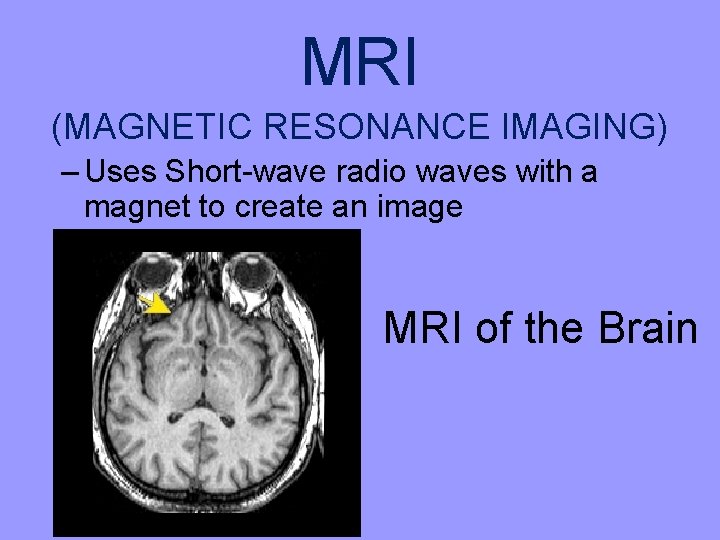 MRI (MAGNETIC RESONANCE IMAGING) – Uses Short-wave radio waves with a magnet to create