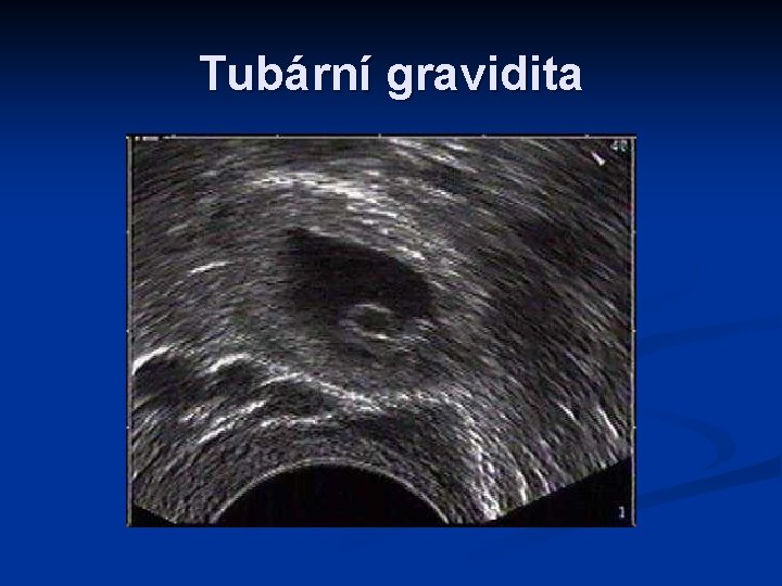 Tubární gravidita 