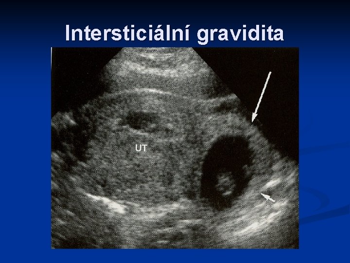 Intersticiální gravidita 