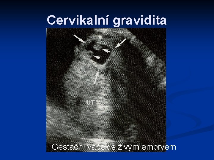 Cervikalní gravidita n Gestační váček s živým embryem 