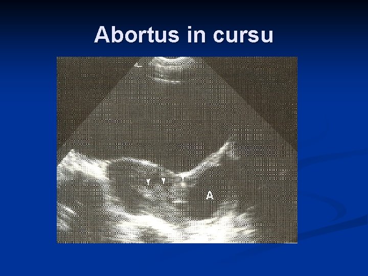 Abortus in cursu 