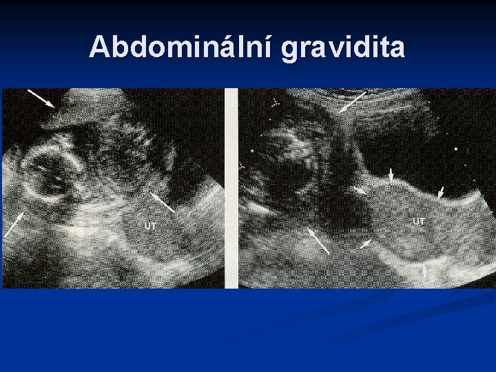 Abdominální gravidita 