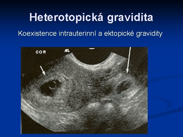 Heterotopická gravidita Koexistence intrauterinní a ektopické gravidity 