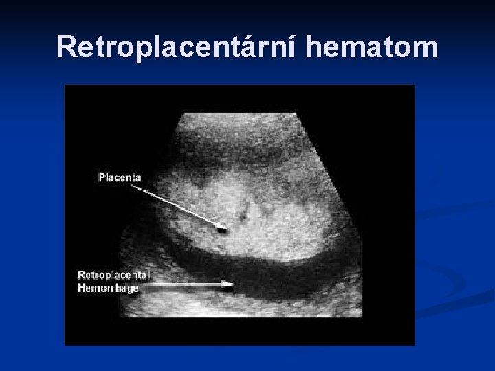 Retroplacentární hematom 