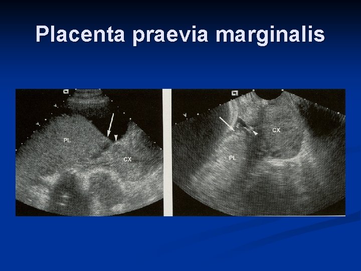 Placenta praevia marginalis 