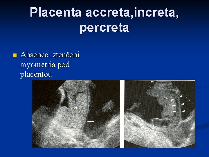 Placenta accreta, increta, percreta n Absence, ztenčení myometria pod placentou 