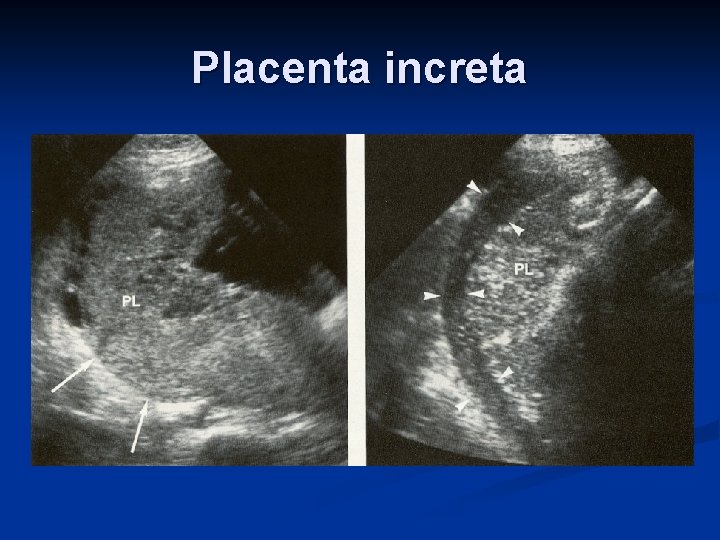 Placenta increta 
