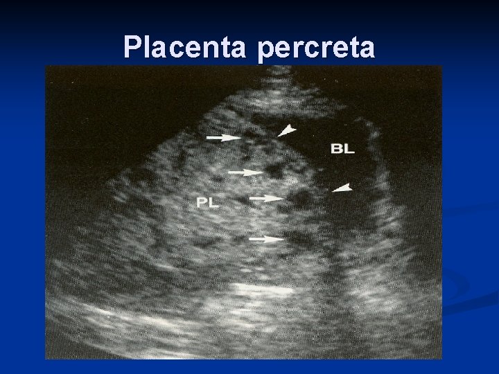 Placenta percreta 