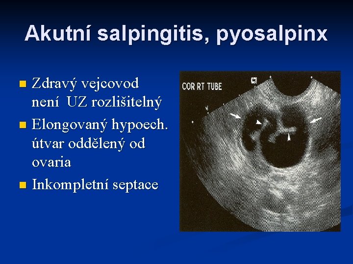 Akutní salpingitis, pyosalpinx Zdravý vejcovod není UZ rozlišitelný n Elongovaný hypoech. útvar oddělený od