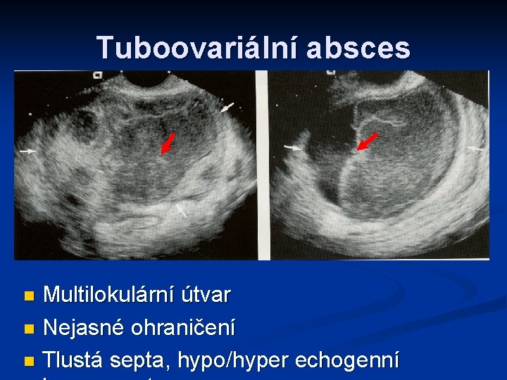 Tuboovariální absces Multilokulární útvar n Nejasné ohraničení n Tlustá septa, hypo/hyper echogenní n 