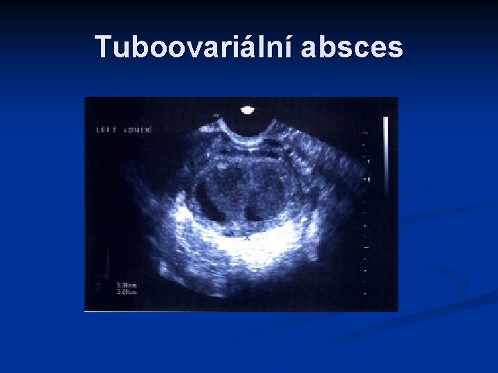 Tuboovariální absces 