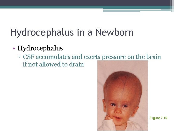 Hydrocephalus in a Newborn • Hydrocephalus ▫ CSF accumulates and exerts pressure on the