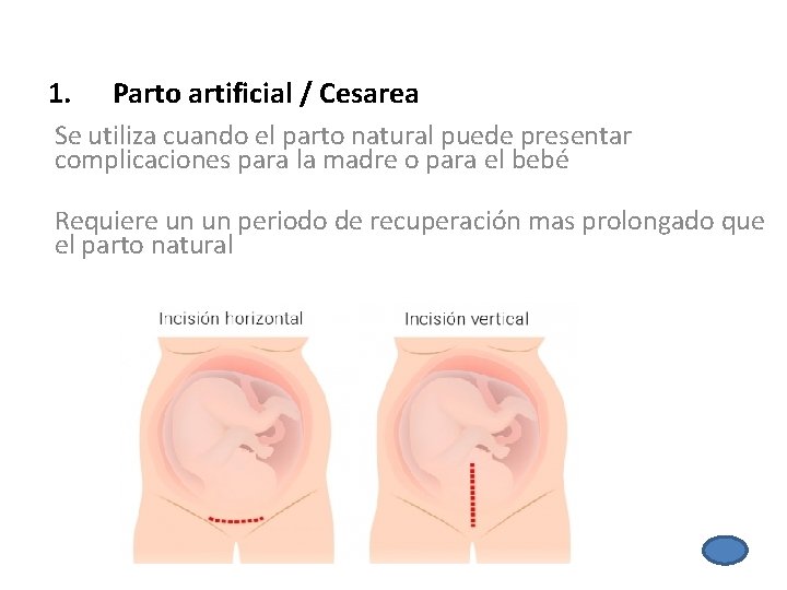 1. Parto artificial / Cesarea Se utiliza cuando el parto natural puede presentar complicaciones