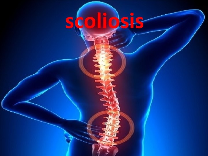 scoliosis 