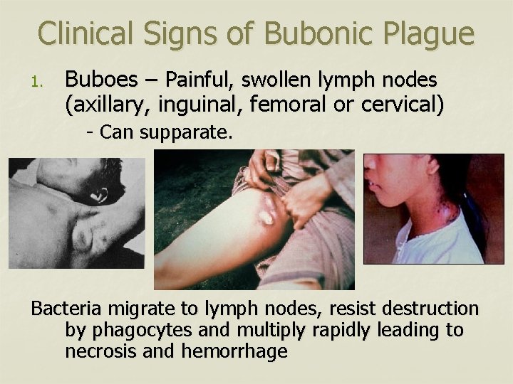 Clinical Signs of Bubonic Plague 1. Buboes – Painful, swollen lymph nodes (axillary, inguinal,