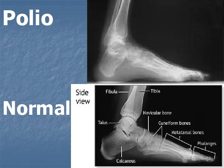 Polio Normal 