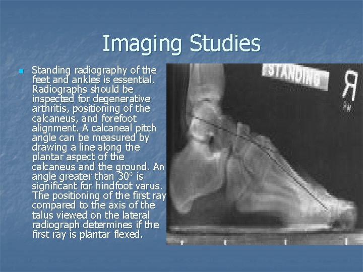 Imaging Studies n Standing radiography of the feet and ankles is essential. Radiographs should