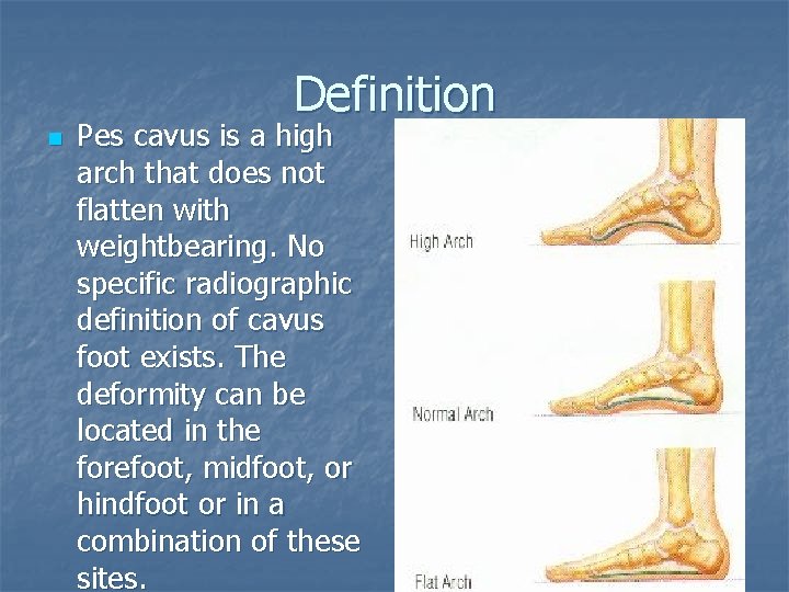 Definition n Pes cavus is a high arch that does not flatten with weightbearing.