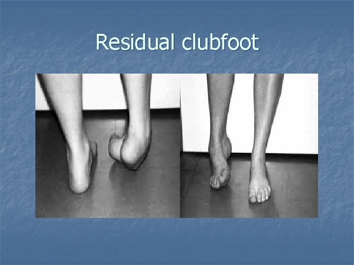 Residual clubfoot 