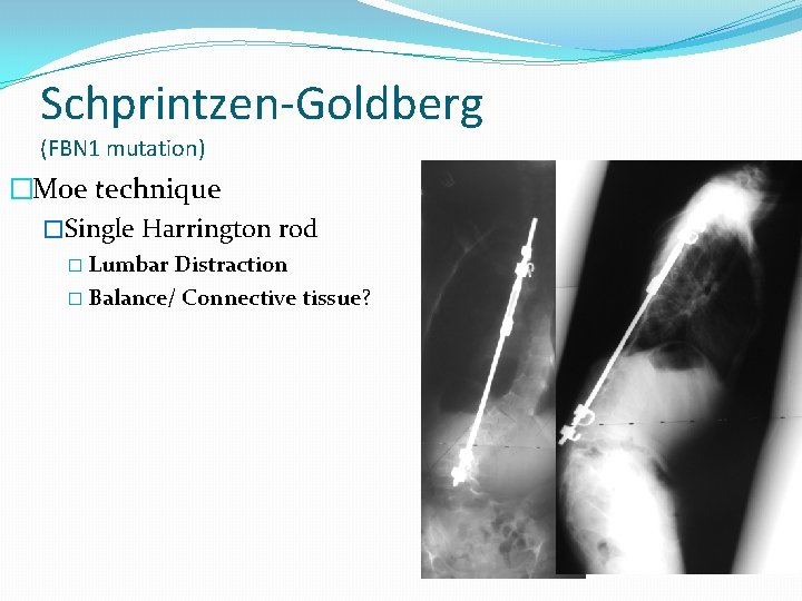 Schprintzen-Goldberg (FBN 1 mutation) �Moe technique �Single Harrington rod � Lumbar Distraction � Balance/