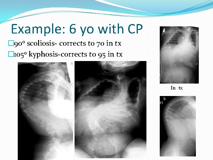 Example: 6 yo with CP � 90 o scoliosis- corrects to 70 in tx